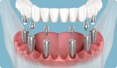 All-on-6 Implants